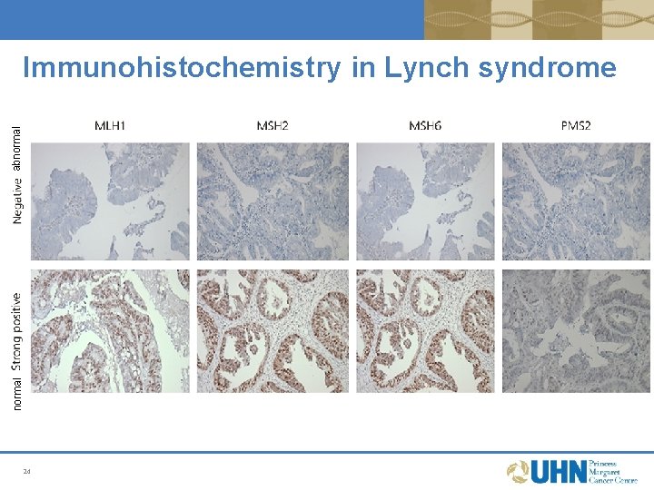 normal abnormal Immunohistochemistry in Lynch syndrome 24 normal abnormal Immunohistochemistry in Lynch syndrome 24