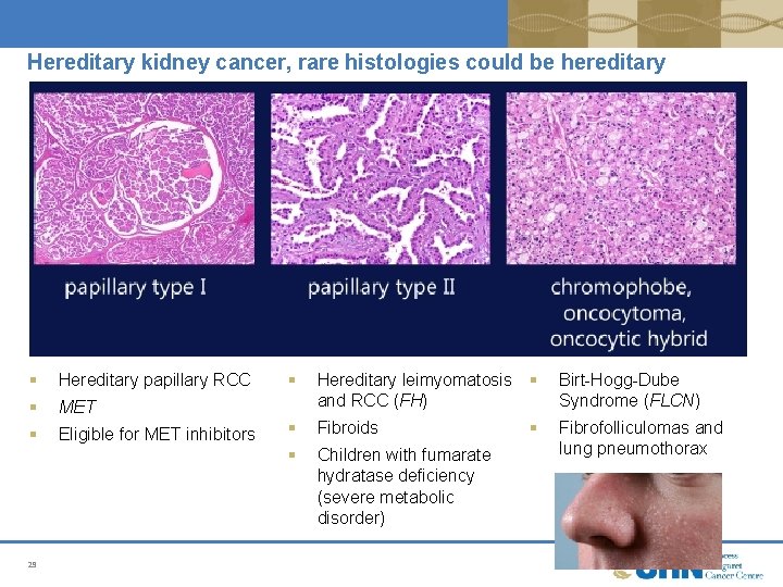Hereditary kidney cancer, rare histologies could be hereditary § Hereditary papillary RCC § MET Hereditary kidney cancer, rare histologies could be hereditary § Hereditary papillary RCC § MET