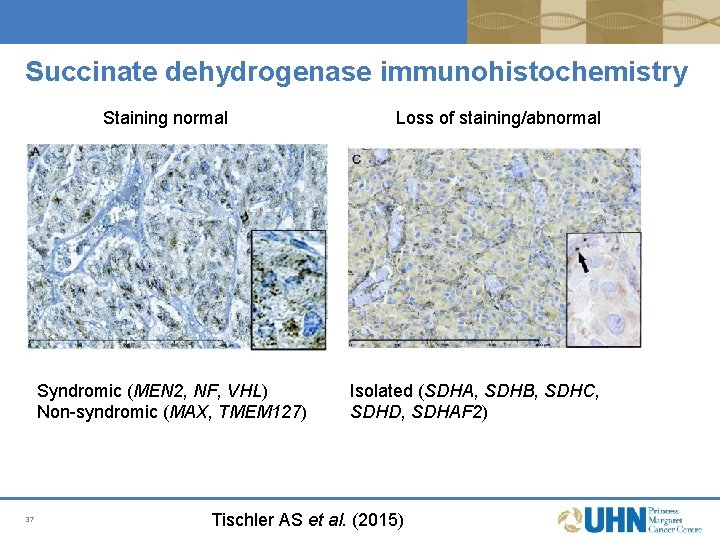 Succinate dehydrogenase immunohistochemistry Staining normal Syndromic (MEN 2, NF, VHL) Non-syndromic (MAX, TMEM 127) Succinate dehydrogenase immunohistochemistry Staining normal Syndromic (MEN 2, NF, VHL) Non-syndromic (MAX, TMEM 127)