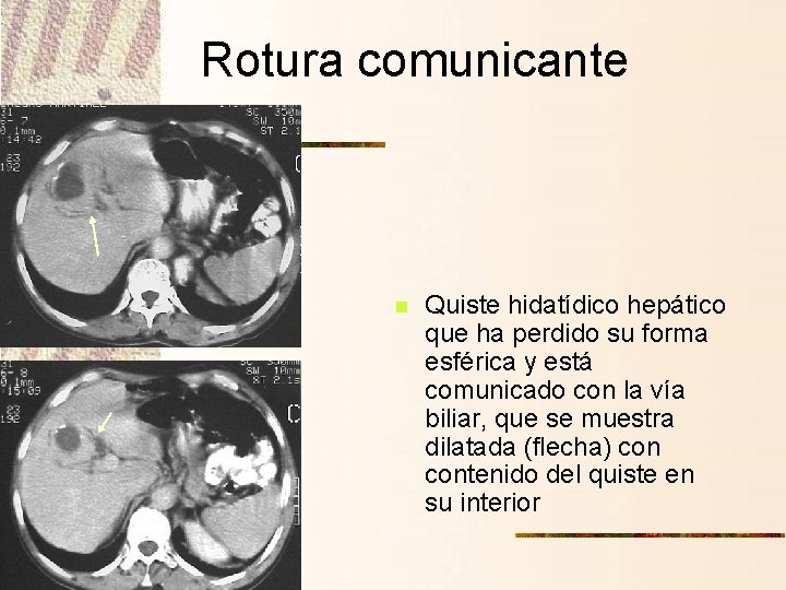 Rotura comunicante n Quiste hidatídico hepático que ha perdido su forma esférica y está