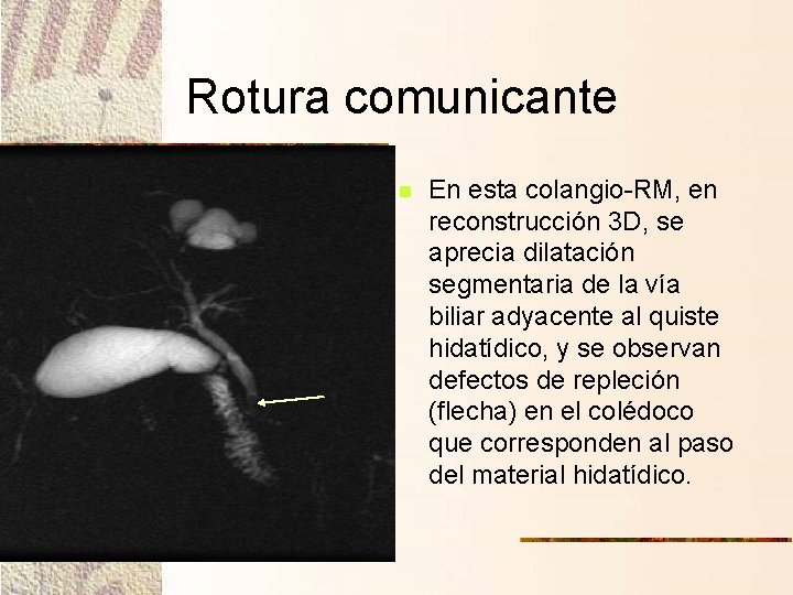 Rotura comunicante n En esta colangio-RM, en reconstrucción 3 D, se aprecia dilatación segmentaria