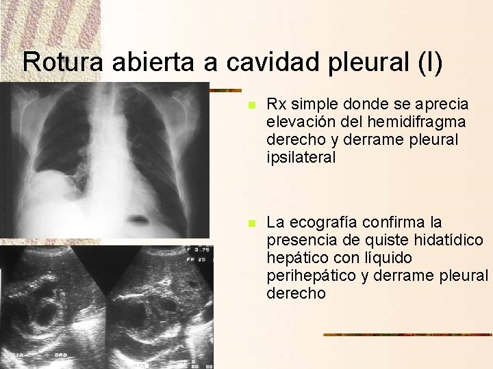 Rotura abierta a cavidad pleural (I) n Rx simple donde se aprecia elevación del