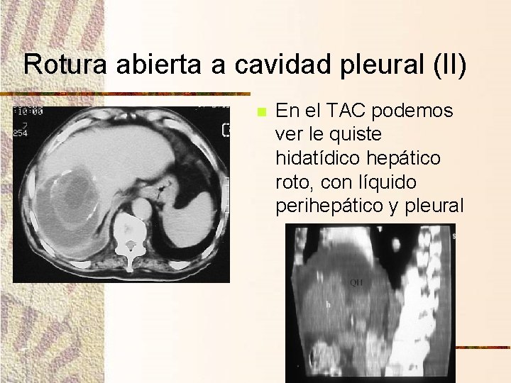 Rotura abierta a cavidad pleural (II) n En el TAC podemos ver le quiste