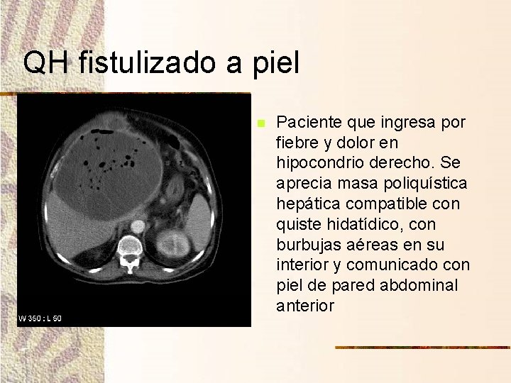 QH fistulizado a piel n Paciente que ingresa por fiebre y dolor en hipocondrio