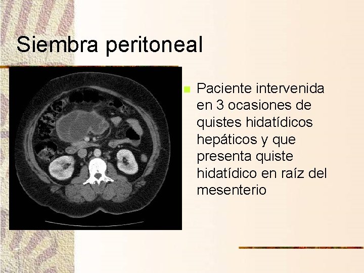 Siembra peritoneal n Paciente intervenida en 3 ocasiones de quistes hidatídicos hepáticos y que