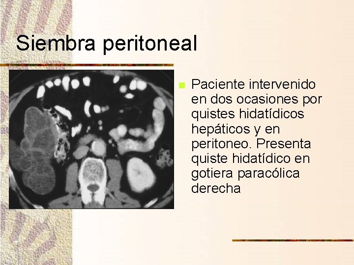 Siembra peritoneal n Paciente intervenido en dos ocasiones por quistes hidatídicos hepáticos y en