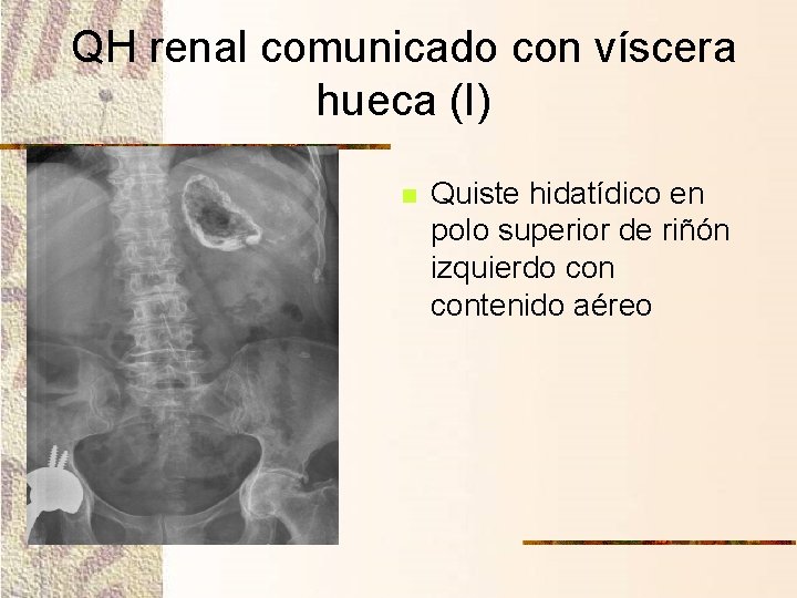 QH renal comunicado con víscera hueca (I) n Quiste hidatídico en polo superior de