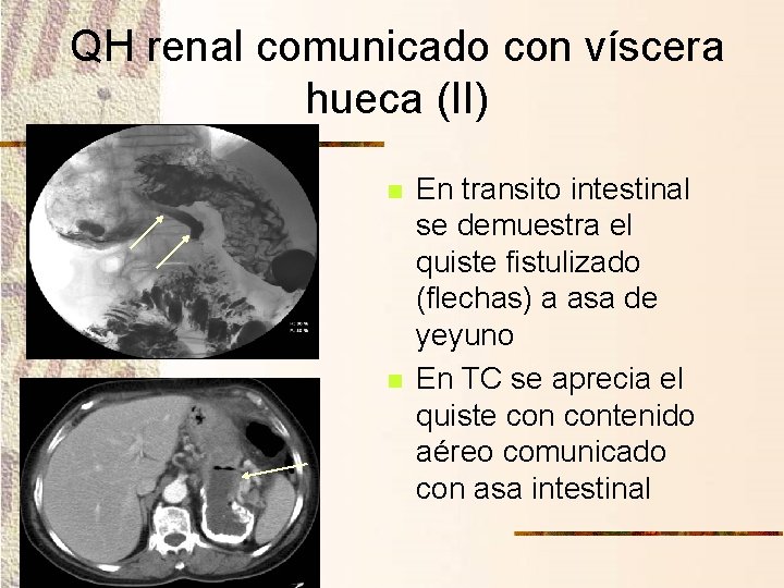 QH renal comunicado con víscera hueca (II) n n En transito intestinal se demuestra