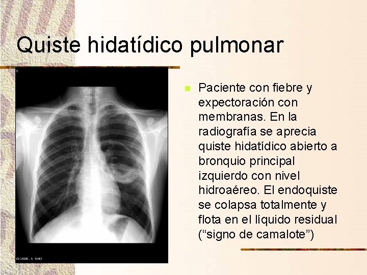 Quiste hidatídico pulmonar n Paciente con fiebre y expectoración con membranas. En la radiografía