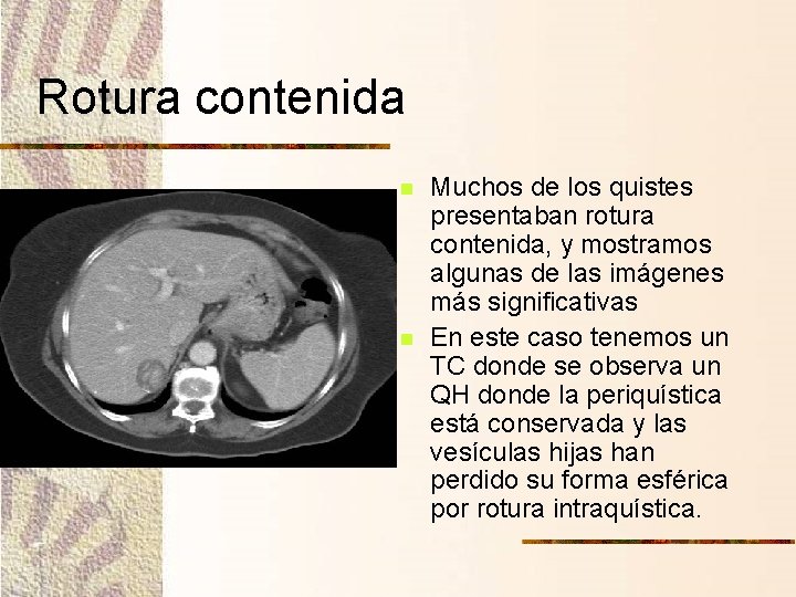 Rotura contenida n n Muchos de los quistes presentaban rotura contenida, y mostramos algunas