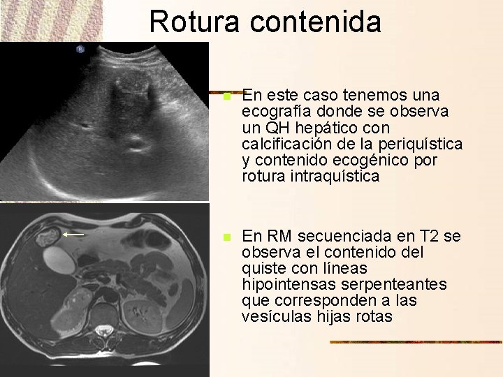 Rotura contenida n En este caso tenemos una ecografía donde se observa un QH