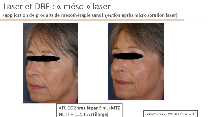 Laser et DBE : « méso » laser (application de produits de mésothérapie sans