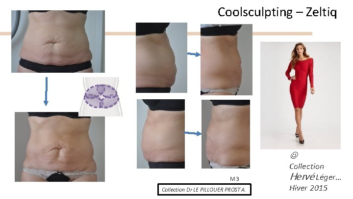 Coolsculpting – Zeltiq M 3 Collection Dr LE PILLOUER PROST A. Collection Hervé Léger…