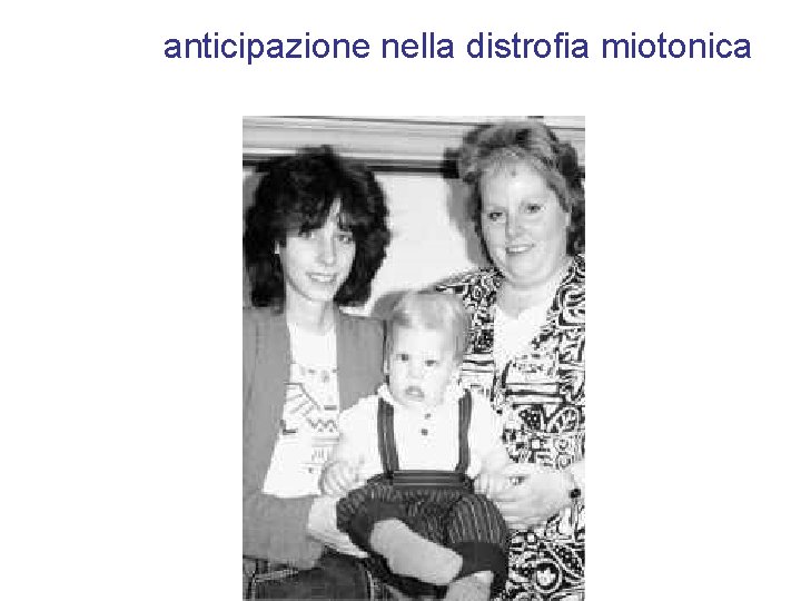 anticipazione nella distrofia miotonica 