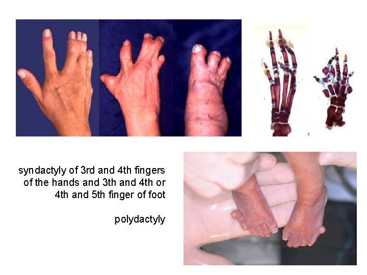 syndactyly of 3 rd and 4 th fingers of the hands and 3 th