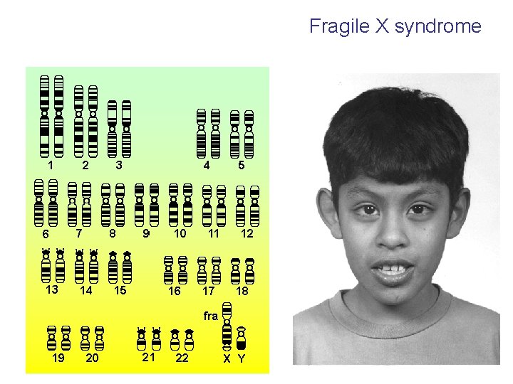 Fragile X syndrome 