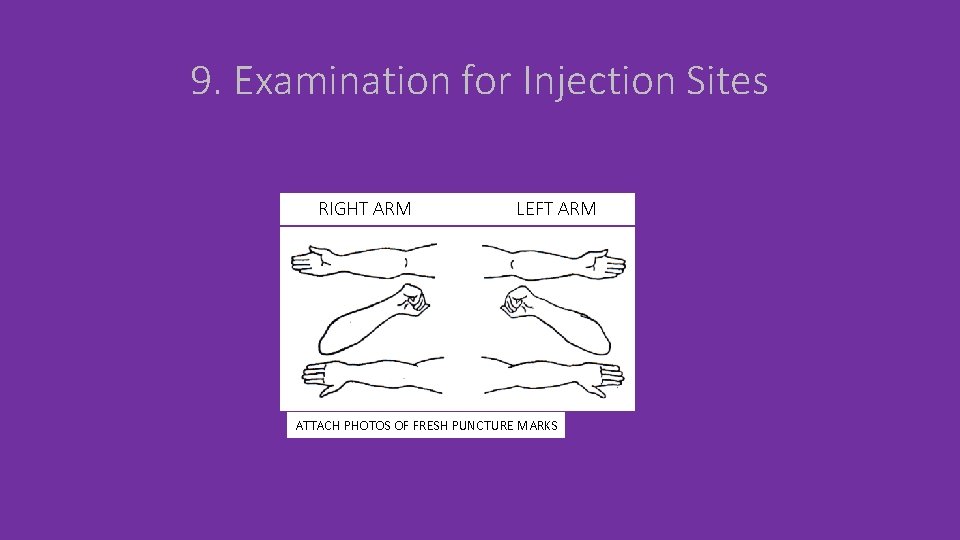 9. Examination for Injection Sites RIGHT ARM LEFT ARM ATTACH PHOTOS OF FRESH PUNCTURE