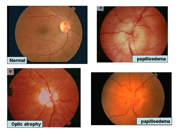 Normal Optic atrophy papilloedema Normal Optic atrophy papilloedema