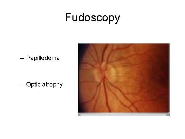 Fudoscopy – Papilledema – Optic atrophy Fudoscopy – Papilledema – Optic atrophy