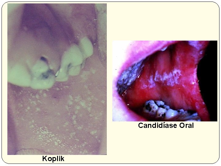 Candidíase Oral Koplik 
