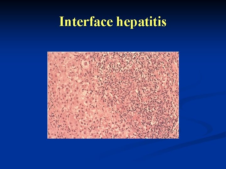 Interface hepatitis 