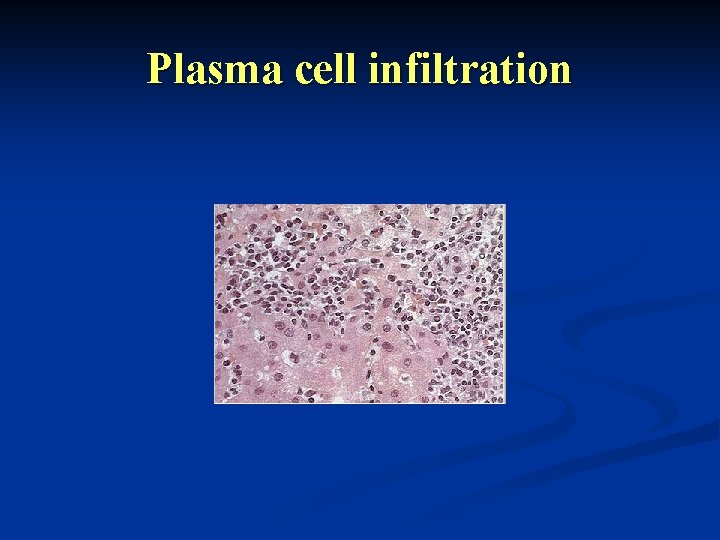 Plasma cell infiltration 