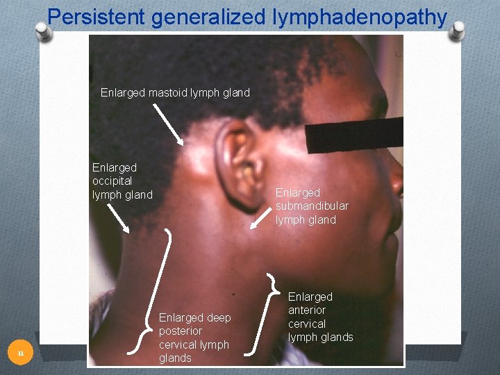 Persistent generalized lymphadenopathy Enlarged mastoid lymph gland Enlarged occipital lymph gland 11 Enlarged submandibular