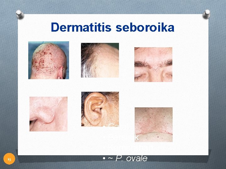 Dermatitis seboroika 13 • Gatal • Bersisik • Kemerahan • ~ P. ovale 
