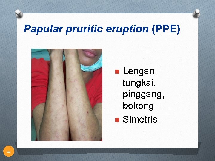 Papular pruritic eruption (PPE) n n 14 Lengan, tungkai, pinggang, bokong Simetris 