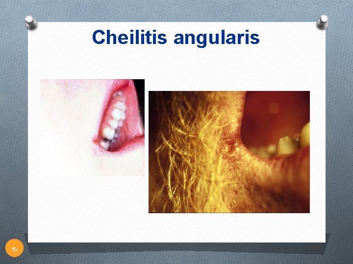 Cheilitis angularis 15 