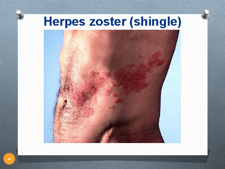 Herpes zoster (shingle) 16 