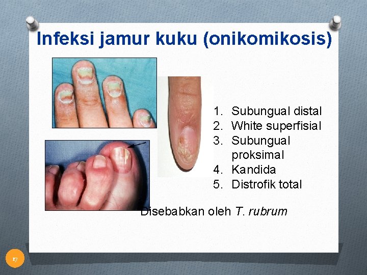 Infeksi jamur kuku (onikomikosis) 1. Subungual distal 2. White superfisial 3. Subungual proksimal 4.