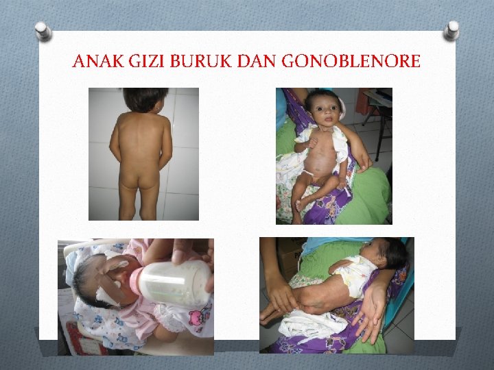 ANAK GIZI BURUK DAN GONOBLENORE 