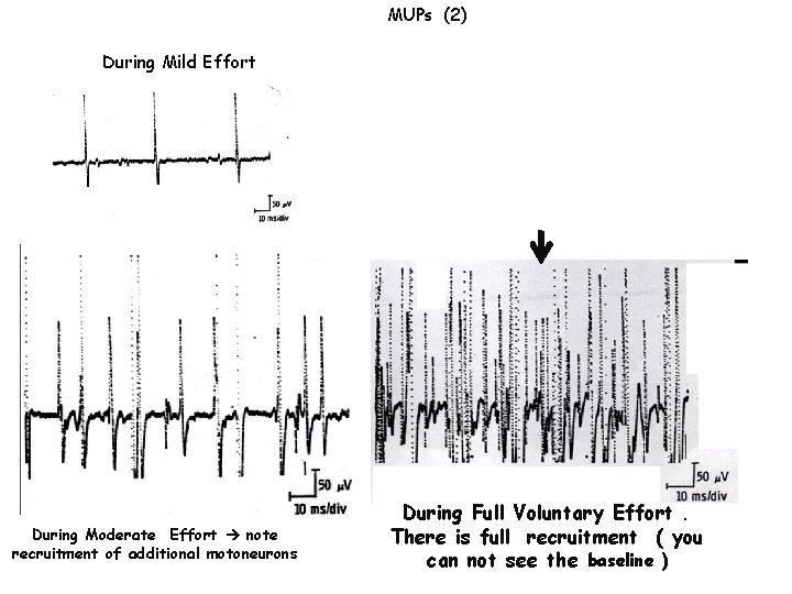 MUPs (2) During Mild Effort During Moderate Effort note recruitment of additional motoneurons During