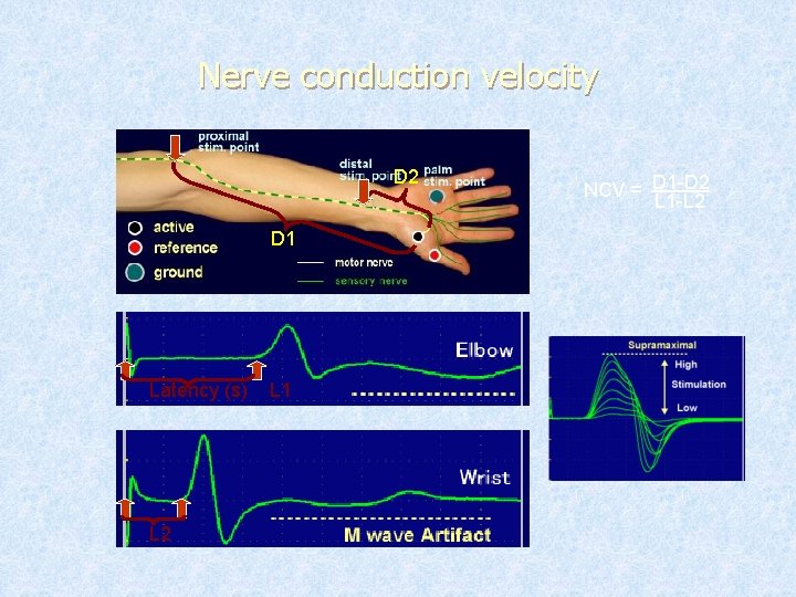 Nerve conduction velocity D 2 D 1 Latency (s) L 2 L 1 NCV