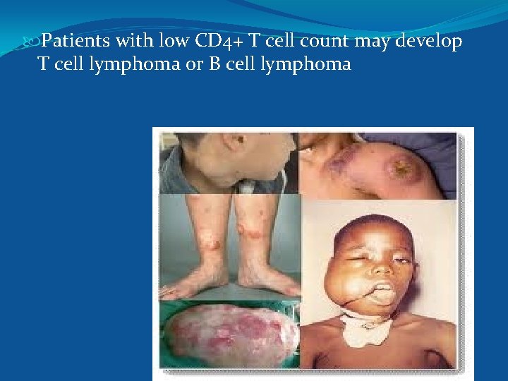  Patients with low CD 4+ T cell count may develop T cell lymphoma