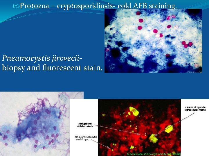  Protozoa – cryptosporidiosis- cold AFB staining, Pneumocystis jiroveciibiopsy and fluorescent stain, 