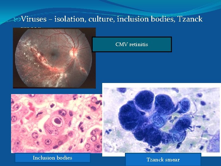  Viruses – isolation, culture, inclusion bodies, Tzanck smear. CMV retinitis Inclusion bodies Tzanck