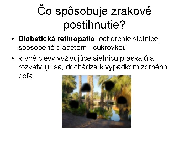 Čo spôsobuje zrakové postihnutie? • Diabetická retinopatia: ochorenie sietnice, spôsobené diabetom - cukrovkou •