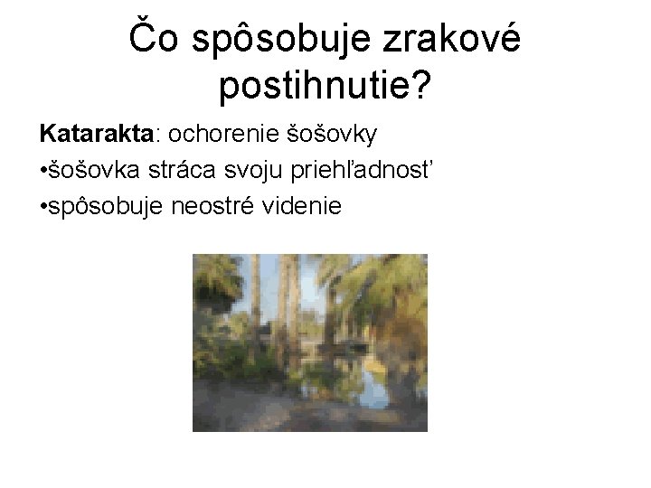 Čo spôsobuje zrakové postihnutie? Katarakta: ochorenie šošovky • šošovka stráca svoju priehľadnosť • spôsobuje