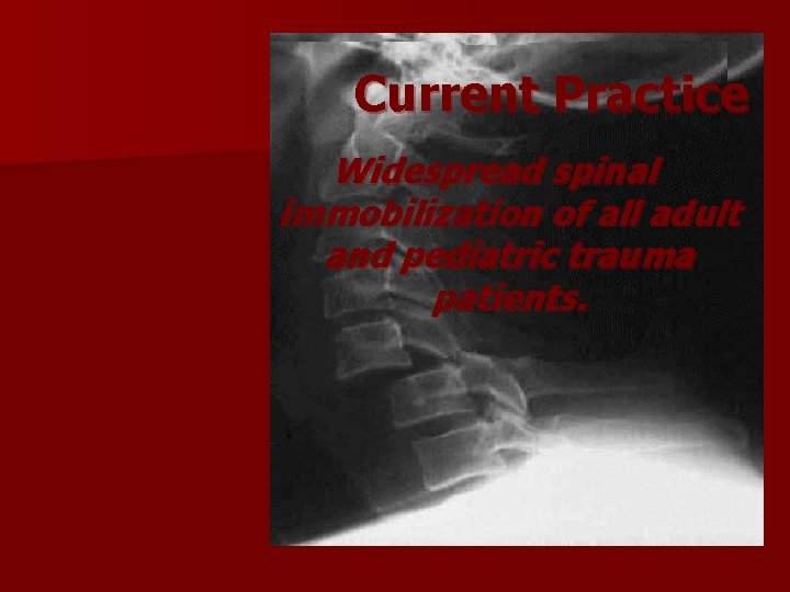 Current Practice Widespread spinal immobilization of all adult and pediatric trauma patients. Current Practice Widespread spinal immobilization of all adult and pediatric trauma patients.