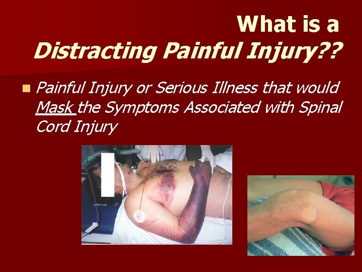 What is a Distracting Painful Injury? ? n Painful Injury or Serious Illness that What is a Distracting Painful Injury? ? n Painful Injury or Serious Illness that
