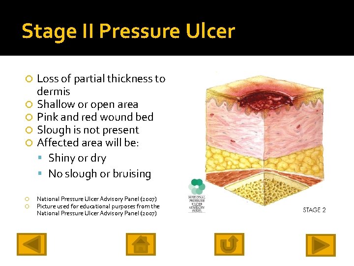 Stage II Pressure Ulcer Loss of partial thickness to dermis Shallow or open area