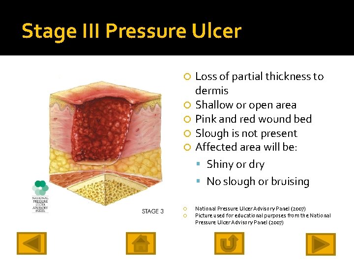 Stage III Pressure Ulcer Loss of partial thickness to dermis Shallow or open area