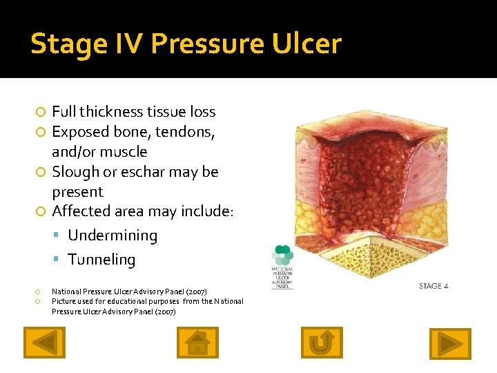 Stage IV Pressure Ulcer Full thickness tissue loss Exposed bone, tendons, and/or muscle Slough