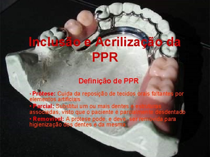 Inclusão e Acrilização da PPR Definição de PPR • Prótese: Cuida da reposição de