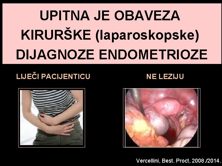 UPITNA JE OBAVEZA KIRURŠKE (laparoskopske) DIJAGNOZE ENDOMETRIOZE LIJEČI PACIJENTICU NE LEZIJU Vercellini, Best. Proct, UPITNA JE OBAVEZA KIRURŠKE (laparoskopske) DIJAGNOZE ENDOMETRIOZE LIJEČI PACIJENTICU NE LEZIJU Vercellini, Best. Proct,