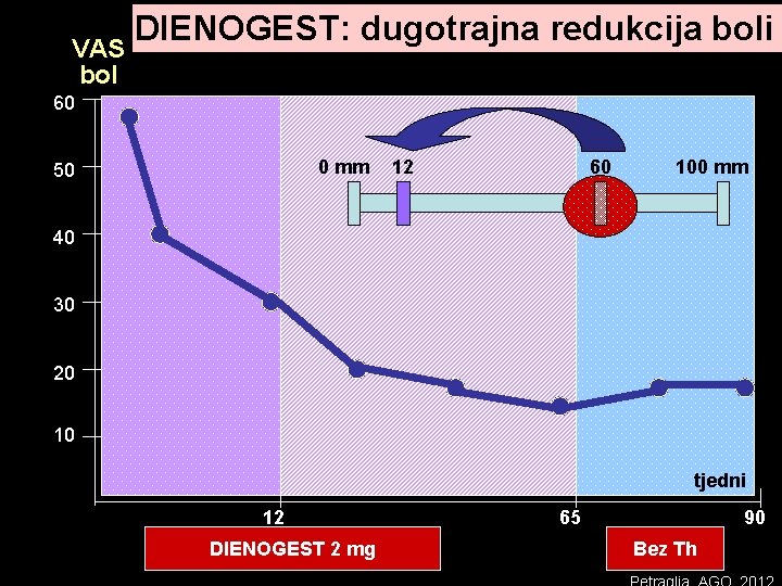 DIENOGEST: dugotrajna redukcija boli VAS bol 60 0 mm 50 12 60 100 mm DIENOGEST: dugotrajna redukcija boli VAS bol 60 0 mm 50 12 60 100 mm