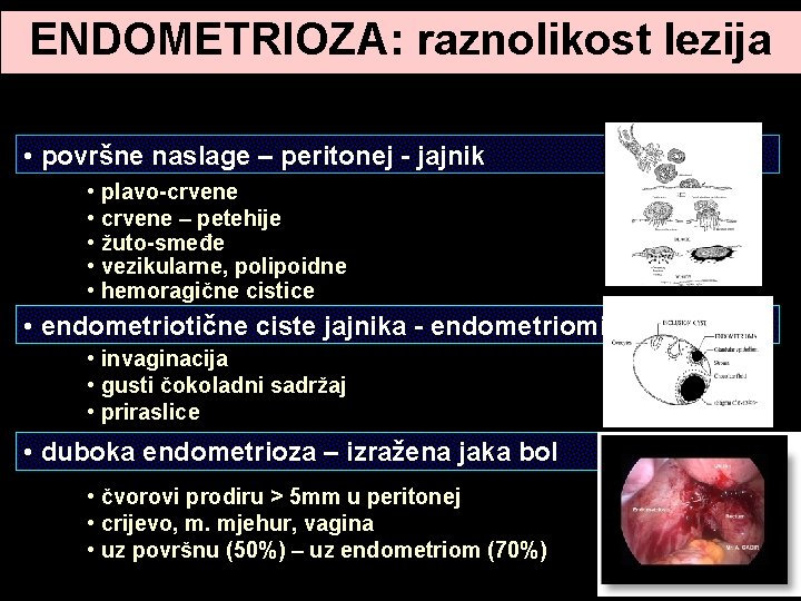 ENDOMETRIOZA: raznolikost lezija • površne naslage – peritonej - jajnik • plavo-crvene • crvene ENDOMETRIOZA: raznolikost lezija • površne naslage – peritonej - jajnik • plavo-crvene • crvene