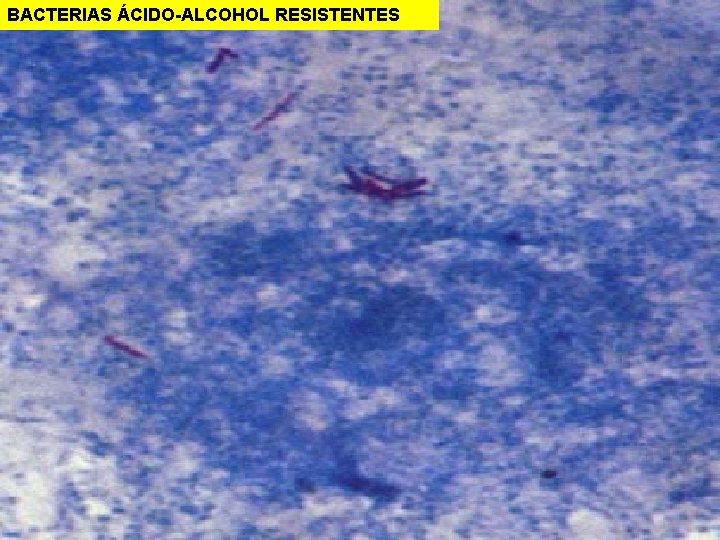 BACTERIAS ÁCIDO-ALCOHOL RESISTENTES 